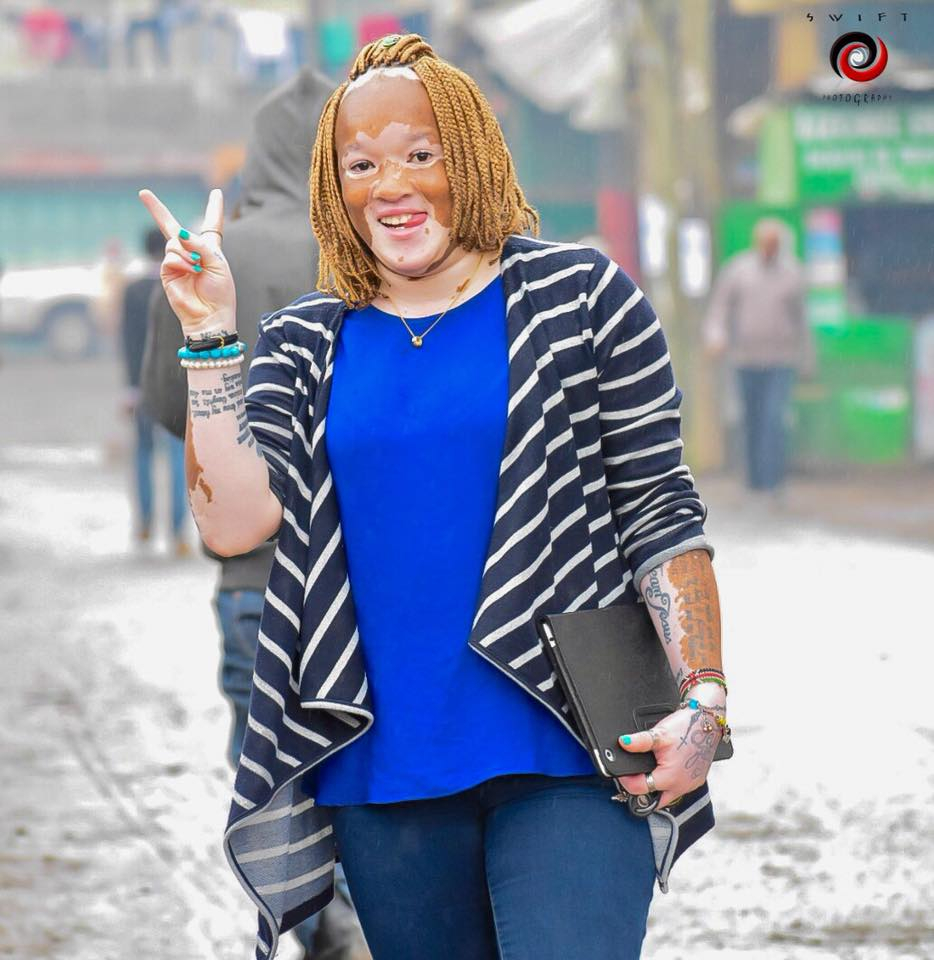 Elizabeth Wangui: Vitiligo And Albinism Advocate - Paukwa